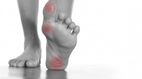 plantar fasciitis